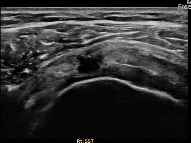 최ㅇㅇ님 시술 전