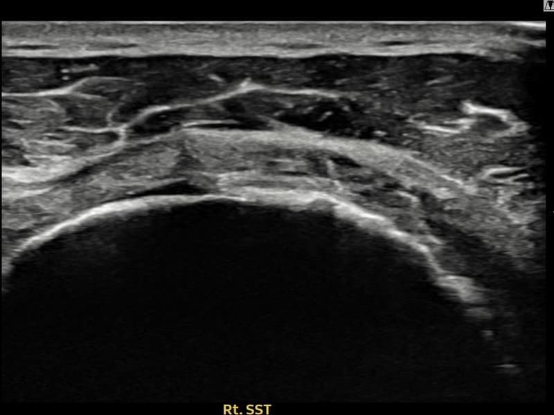 病例No.14 — 术后