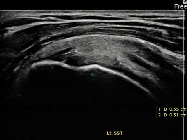 서ㅇㅇ님 시술 전