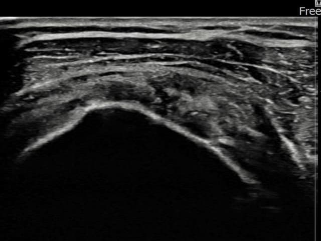 서ㅇㅇ님 시술 후