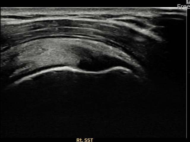 허ㅇㅇ님 시술 전