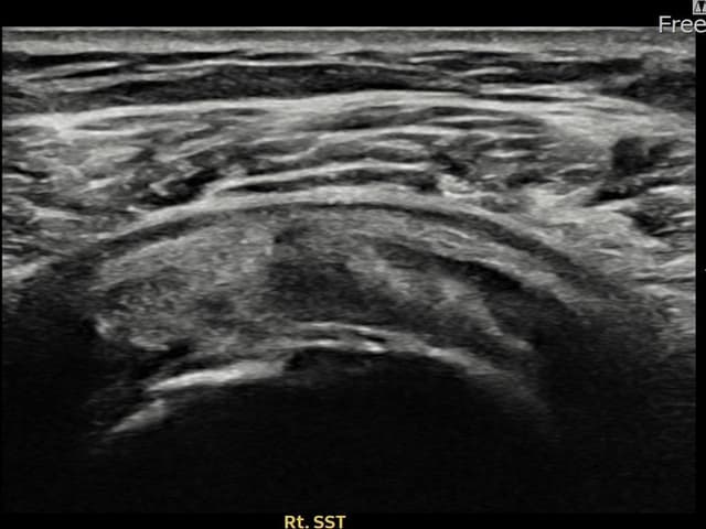 최ㅇㅇ님 시술 후