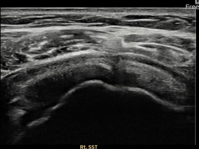 최ㅇㅇ님 시술 전
