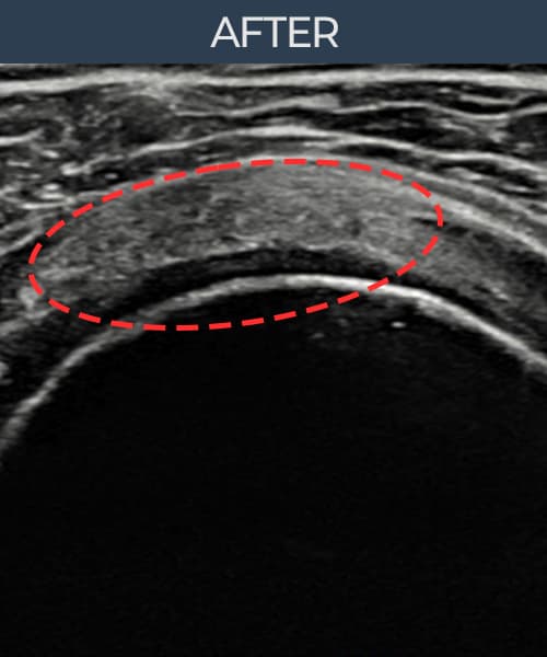 症例 No.5 — 施術後