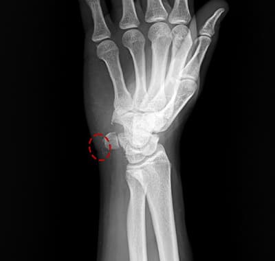 석회성건염 시술 후 X-ray — 석회 완전 제거 확인