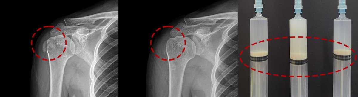 석회성건염 시술 전 X-ray — 어깨 힘줄에 석회 침착 확인