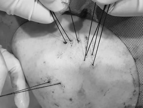 어깨인대 봉합 완료 — 인대를 뼈에 고정