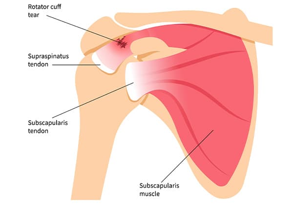 회전근개 파열 해부학 — 힘줄 파열 단면