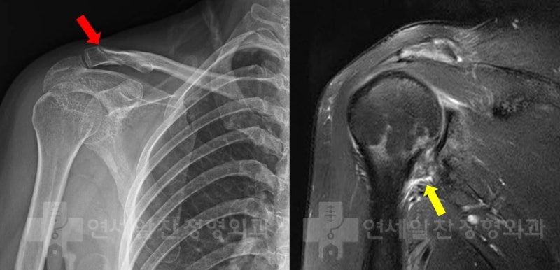 X-ray 상에서 빨간색 화살표로 표시된 부위에 쇄골의 골절 소견이 보이며 유합이 된 것이 관찰된다. MRI 상에서도 하방관절낭의 심한 유착 및 염증 소견이 관찰된다.