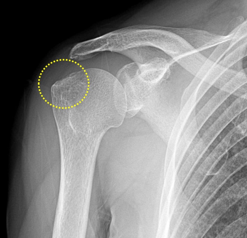 노란 점선안에 상완골의 대결절이 보이는데 이 부위가 회전근개가 부착되는 부위 입니다. 그런데 부착부의 뼈의 모양이 울퉁불퉁 한 것이 보입니다. 즉 회전근개 손상이 되었을 가능성이 아주 많은 X-ray  소견을 보입니다.