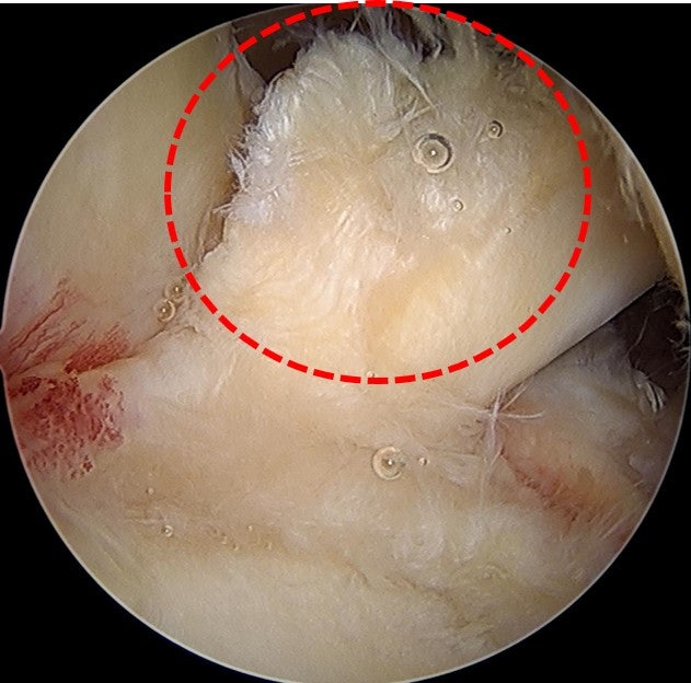 빨간 원안의 이두장겅이 부분적으로 파열되 모습이 관찰됩니다.