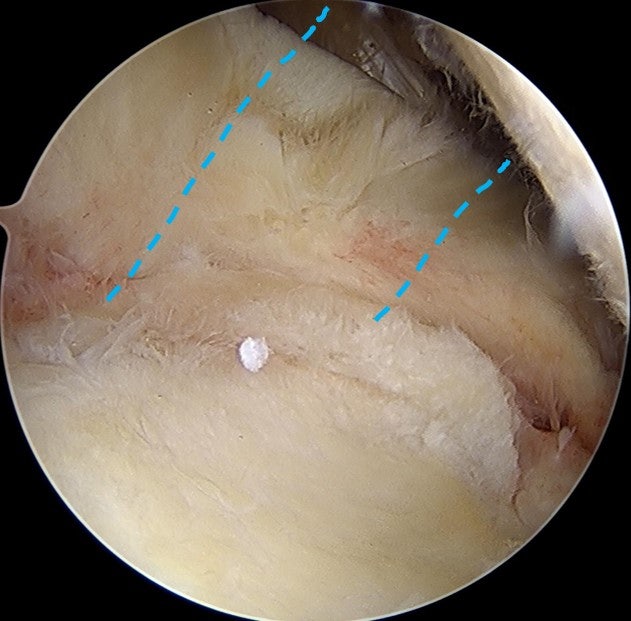 이두장건 절제술을 하고 난 모습입니다.