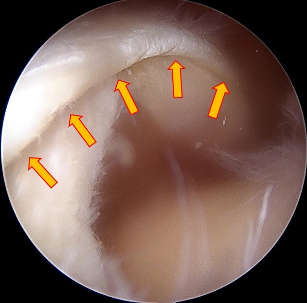 화살표로 표시된 부위가 회전근개가가 광범위 하게 파열되어 덜렁거리는 모습이며 대결절까지 해부학적으로 복원되지 않는 것을 확인하였습니다.