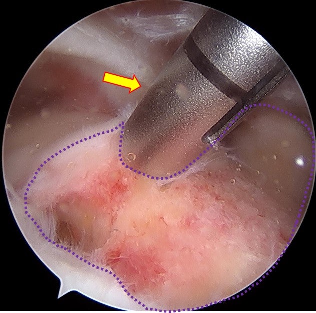 대결절 부위에 적절한 조치를 하여 미세출혈이 이어나게 합니다. 이것이 조직을 치유시키는데 매우 중요한 역할을 하게 됩니다. 그런 봉합나사못(화살표)을 고정합니다.