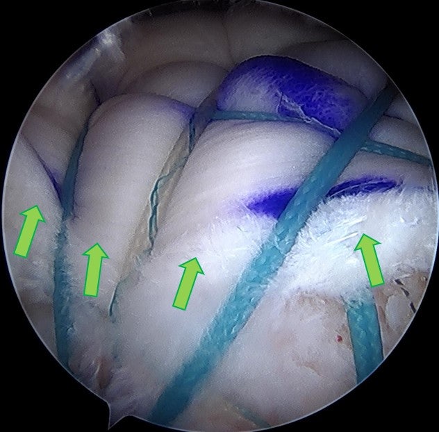 화살표로 표시된 것이 인조인대(allomend)이며 향 후 이것이 생착이 이루어지면 원래의 인대처럼 작용을 하게 됩니다.