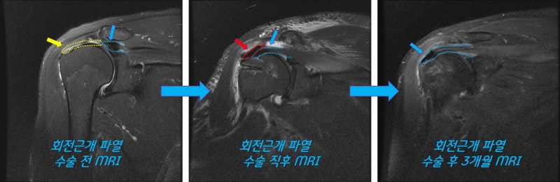 해부학적 복원이 불가했던 광범위한 회전근개파열에서 인조인대를 이용한 회전근개 봉합술 및 보강술로 해부학적 복원이 된 결과입니다.