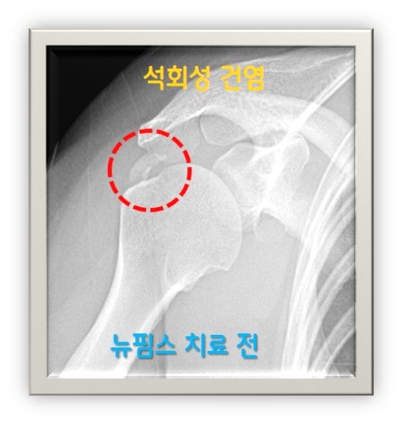 빨간 점선 원 안에 하얗게 보이는 석회가 관찰되며 약 1.5cm 크기의 석회가 관찰됩니다.
