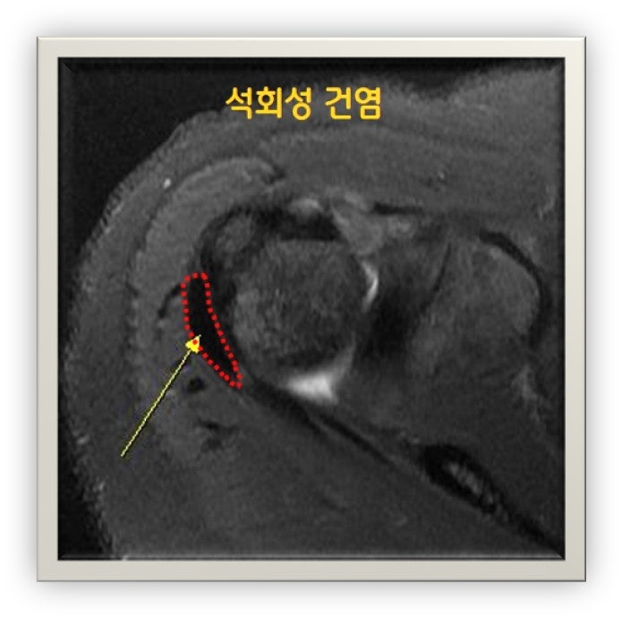 MRI 검사상 극하근에 빨간 점으로 표시된 석회가 관찰됩니다. 크기가 상당히 큰 것으로 통증이 매우 심했습니다.