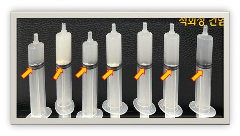 뉴핌스치료(석회분쇄흡입술) 치료 후 주사기에   하얗게 침전된 것이 석회들입니다. 어마어마하게 석회가 나왔습니다.