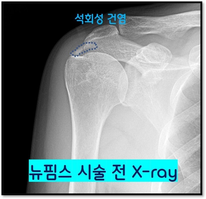x-ray 상 상완골 위쪽으로 파란 점선으로 표시된 부위에 석회가 관찰됩니다. X-ray 소견으로는 어깨 석회성 건염을 진단할 수 있습니다.