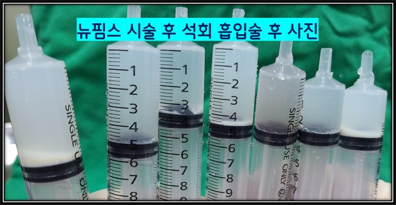 주사기 내부에 보면 하얗게 침전된 것이 어깨 석회성 건염에서 석회를 분쇄해서 흡인한 석회입니다.
