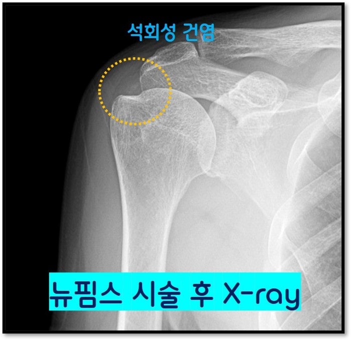 시술 후 X-ray 를 확인한 결과 시술전 보였던 석회가 거의 다 흡수된 것이 확인됩니다.