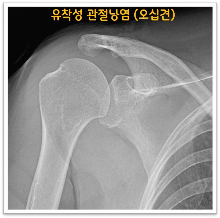 X-ray 상 특이소견은 없었습니다.