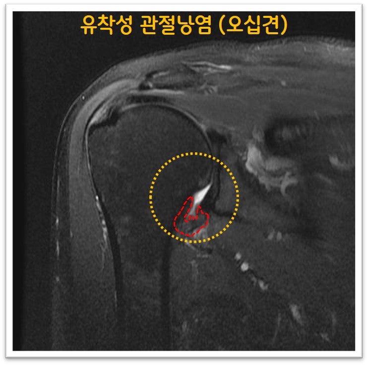 MRI 검사상 빨간 점선으로 표시된 부분이 관절낭인데 이 부위가 상당히 두꺼워져 있으며 유착이 된 소견을 보입니다. 또한 극상근 부위에 약간의 염증 소견도 관찰됩니다.