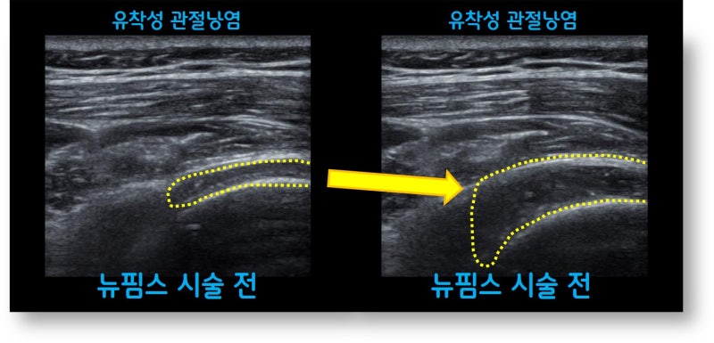 좌측 초음파 사진에서 노란 점선으로 표시된 부위가 관절낭 부위인데 뉴핌스 치료(관절유착박리술) 를 통해 우측의 초음파 사진에서 보이는 것 처럼 관절낭이 부풀려 올라와 넓어진 것을 확인 할 수 있습니다.