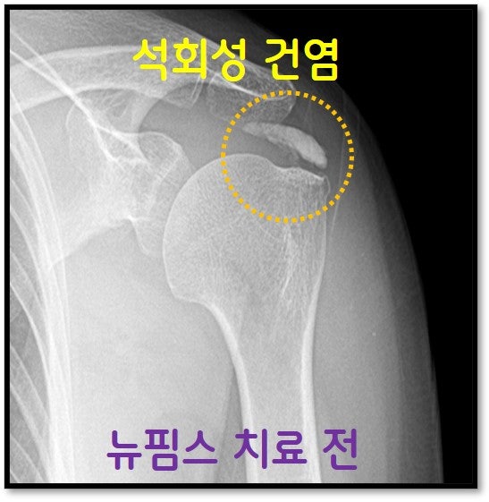X-ray 상 노란색 원 안에 있는 엄청난 크기의 석회가 관찰됩니다.
