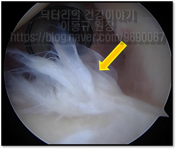 관절경 사진상 전방 관절와순 파열 소견이 보입니다.