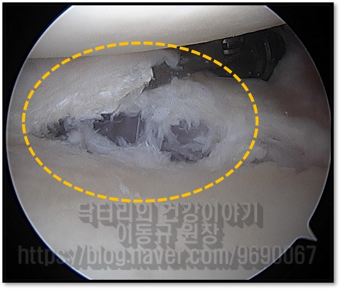전방관절와순이 MRI 소견과 같이 골막까지 파열된 소견이 관찰됩니다.
