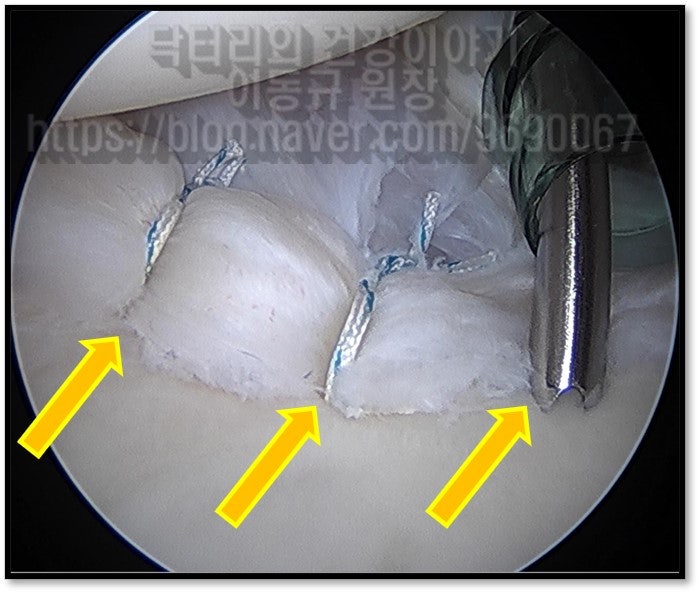 3개의 봉합나사를 통해 단단히 봉합된 모습입니다.