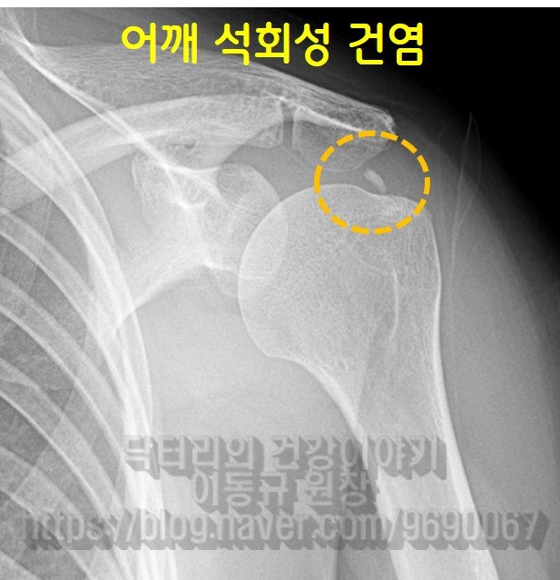 노란 원안에 하얗게 보이는 석회가 관찰됩니다.