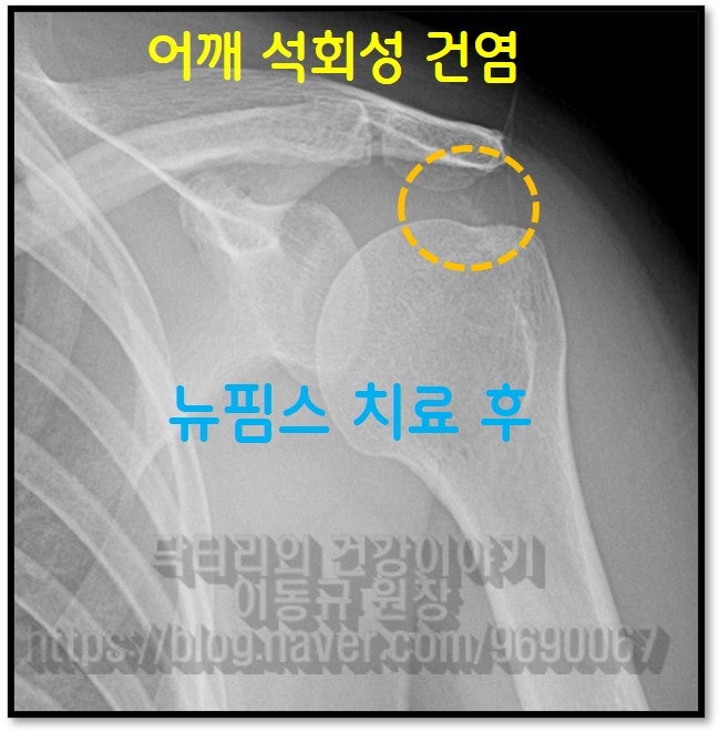 뉴침스치료(석회분쇄흡입술) 한 후 촬영한 X-ray 사진을 보면 시술전 사진과 비교하여 석회가 많이 옅어지고 없어진 것이 확인됩니다.