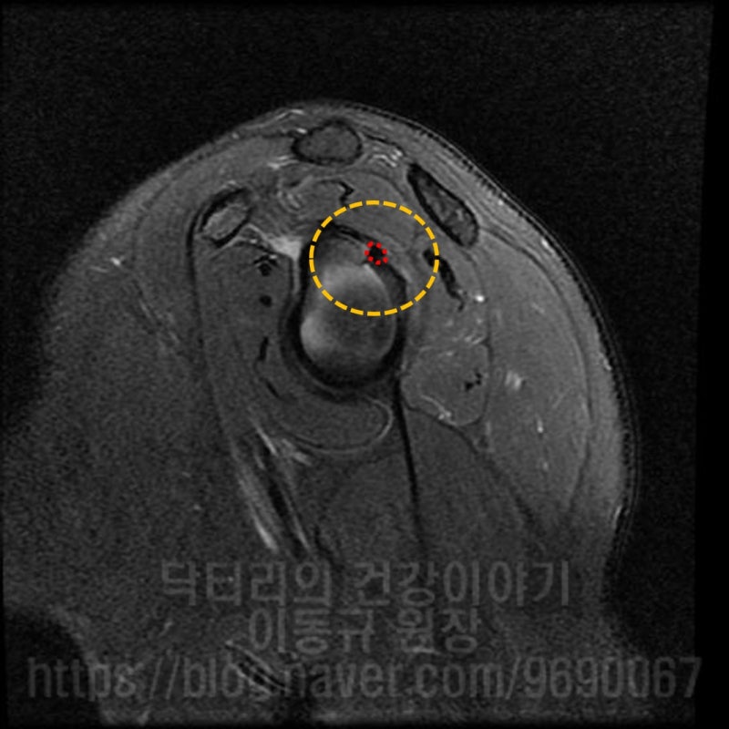 MRI 소견상 후상방 관절와순 과 관절와 사이에 빨간 점선으로 표시된 부위에 석회가 관찰됩니다.