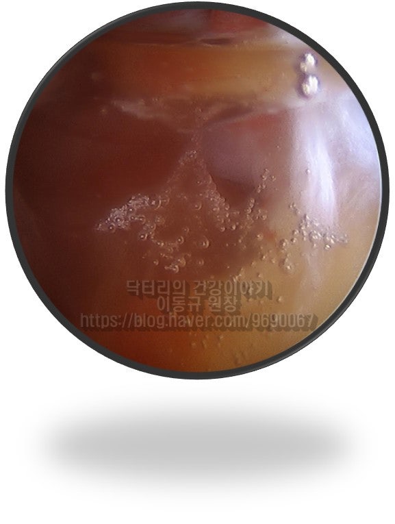 처음 관절경이 삽입 되었을때 약간 붉게 보이는 염증성 활액이 관찰됩니다. 이정도로 보이면 통증이 아주 심했을 것으로 생각됩니다.