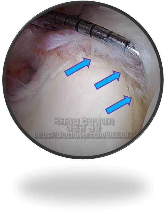 화살표로 표시된 부위가 상부관절와순이 파열된 모습입니다.