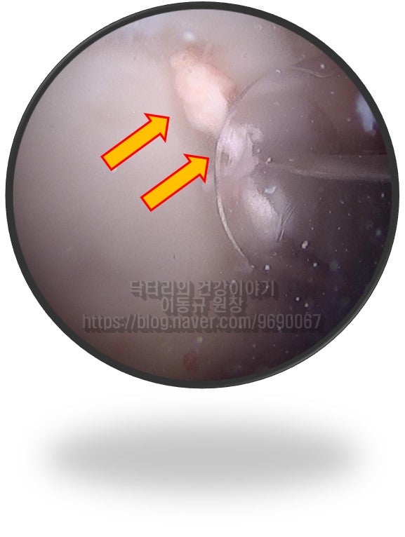 석회가 있는 위치를 정확이 하고 절삭기를 이용하여 석회를 제거하는 사진입니다.