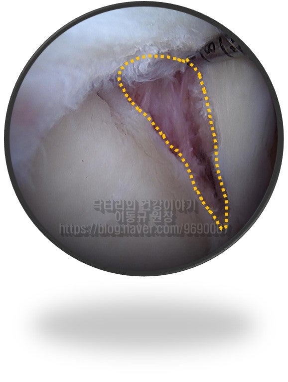 석회를 완벽하게 제거하고 난 후 사진입니다.