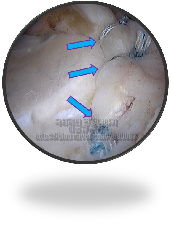 이후 상부관절와순 및 후상방 관절와순을 봉합하여 단단하게 고정된 사진입니다.