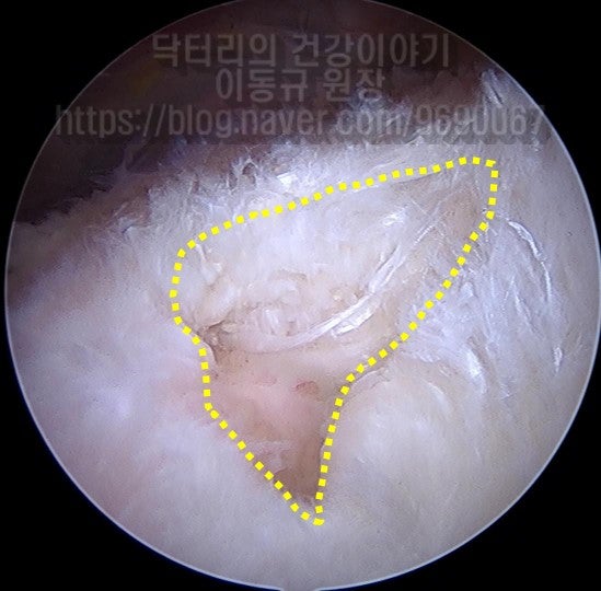 힘줄은 원래 매끈하게 보여야 하는데 너덜너덜하게 파열이 되어있는 것이 보입니다.