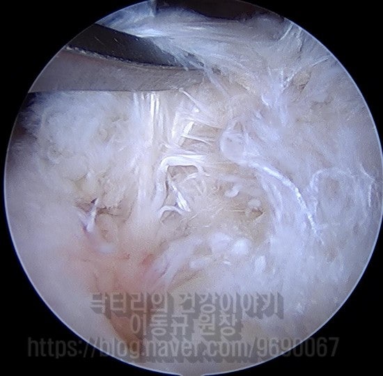 속의 힘줄을 관찰하였을 때 사진에서처럼 완전히 너덜너덜한 상태였으며 힘줄의 기능이 없는 상태였습니다.