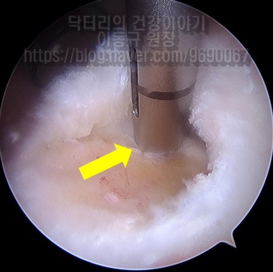 봉합나사못을 삽입하는 사진입니다.