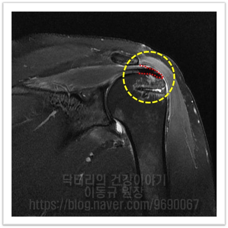 빨간 점선으로 표시된 부위가 수술 당시 결손 부위인데 원래의 힘줄과 인조인대가 완전히 생착되어 하나가 된 모습이 관찰됩니다.