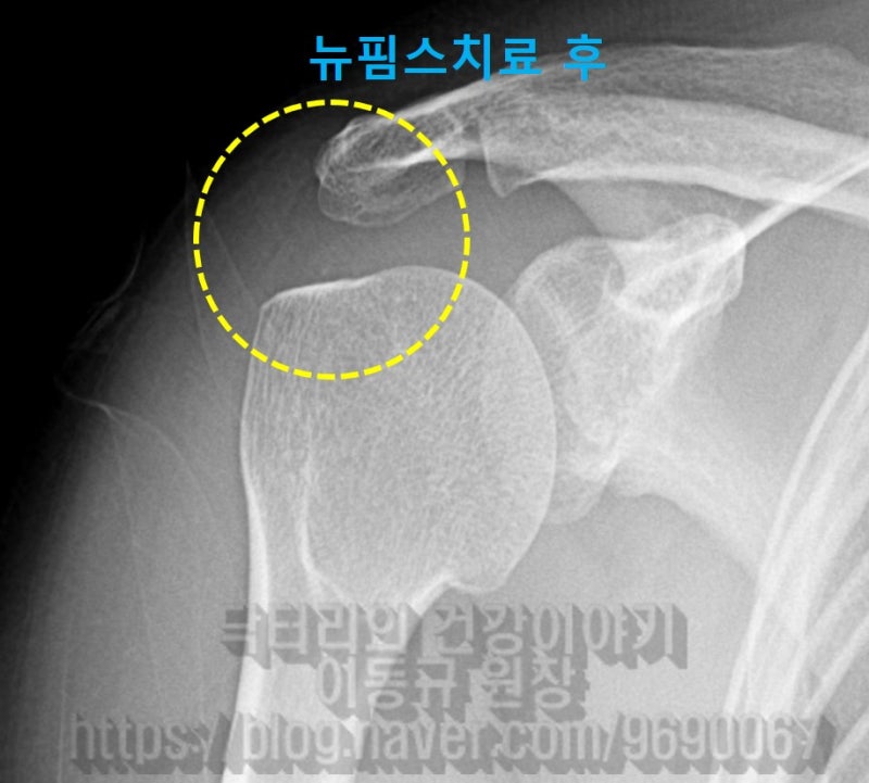 시술 직 후 촬영한 X-ray 입니다. 석회가 거의 사라진 것이 관찰됩니다.