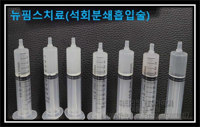 뉴핌스치료(석회분쇄흡입술)을 하고 난 후 주사기 사진에서 보면 하얗게 침착된 많은 양의 석회가 관찰됩니다.