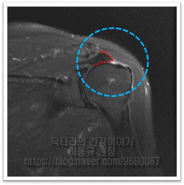 MRI 사진에서 보면 파란 원안에 빨간 점선을 표시된 것이 파열된 회전근개(극상근) 입니다. 상완골의 foot print 에 부착되어야 할 부위가 완전히 떨어져 나가서 약 1.5cm 가량 위축된 것이 관찰됩니다.
