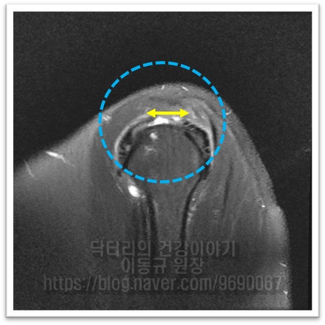이 MRI 사진은 어깨를 옆에서 본 사진이빈다. 노란색 화살표로 표시된 부위가 파열된 회전근개이며 파열 크기를 관찰할 수 있습니다. 약 2cm 가량 파열된 것이 관찰됩니다.