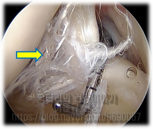 이두정간의 파열 소견이 보입니다. 이두장건은 관절경 사진상 매끈하고 반짝반짝하게 보여야 하는데 너덜너덜하게 된 것이 파열된 이두장건 입니다.